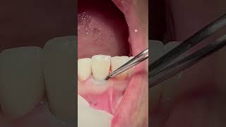 Retraction cord dentist dental teeth viral [upl. by Guthrey54]