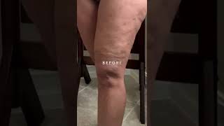 My Fascia Blaster Experience Cellulite Before amp After [upl. by Juli]