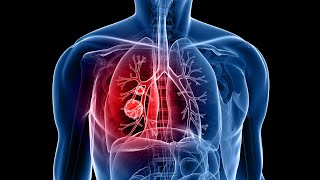 Adenocarcinoma transformation to small cell lung cancer with C797S acquire resistance to osimertinib [upl. by Godric]