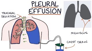 Understanding Pleural Effusions [upl. by Akiam585]