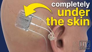 100 INVISIBLE Cochlear Implant  Acclaim by Envoy Medical [upl. by Sydney]