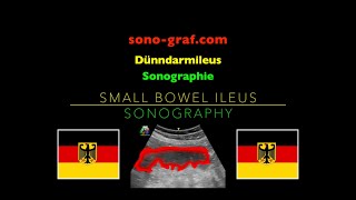 Sonographie  Dünndarmileus [upl. by Rowe]