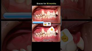 18 months braces process 😱braces dentalbraces orthodontist dentistry [upl. by Esorylime580]