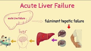 Acute Liver Failure Or Fulminant Hepatic Failure  Sign Symtoms  Causes  Risk Factors  Treatment [upl. by Ludwigg907]