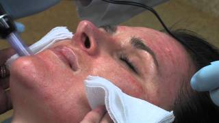 Dr Mark B Taylor Review of Dermapen Micro Needling  Gateway Aesthetics [upl. by Aliam997]