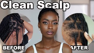 HOW GET RID OF FLAKY SCALP ITCHY SCALP DANDRUFF WITHOUT WASHING BRAIDS [upl. by Aveer]