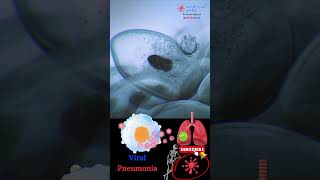 Pneumonia  Respiratory infection  Viral pneumonia  Medical Arts shorts [upl. by Bigler]