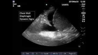 Lung and Pleural Ultrasound Interpretation [upl. by Etiuqram]