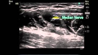 How to Ultrasound Guided Axillary Brachial Plexus Nerve Block [upl. by Anyg]