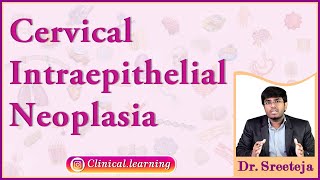 50 Cervical Intraepithelial Neoplasia [upl. by Esinad]