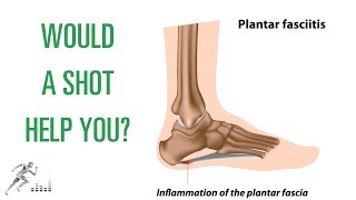 Should you get a cortisone shot for plantar fasciitis [upl. by Parik]