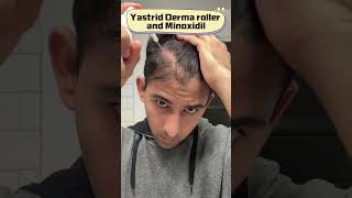 How to use derma roller for hair growth treatment [upl. by Erodroeht]