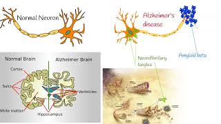 Alzheimers disease  First Symptoms Progression and Prognosis [upl. by Helenka]