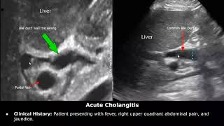 Bile Duct Ultrasound Reporting  CBD amp Hepatic Duct Pathologies amp Diseases  How To Write USG Report [upl. by Eek]