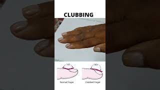 CLUBBING  HYPONYCHIAL ANGLE LOVIBOND ANGLE  PROFILE SIGN [upl. by Akiv]