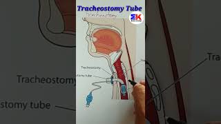 tracheostomy Tube shorts [upl. by Okiek]