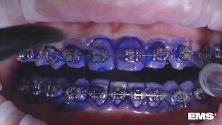 Cleaning Orthodontic Appliances with GBT Guided Biofilm Therapy [upl. by Kroy]