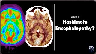 Hashimoto Encephalopathy Is Your Brain at Risk [upl. by Atilrahc632]