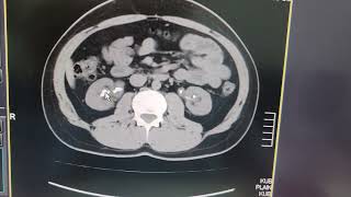 Bilateral renal calculi  Left ureteric calculus  CT KUB [upl. by Cissiee]