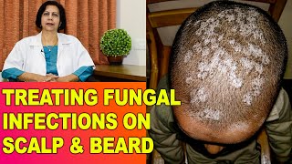 FungalFangal Infections Itching in HeadScalp amp Beard  Treatment  Dr Vijaylaxmi Singh [upl. by Waers256]