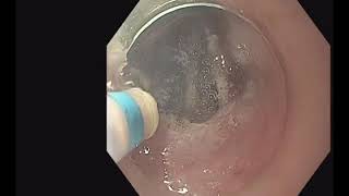 Endoscopic Submucosal Dissection Technique in the Esophagus [upl. by Annatnom]