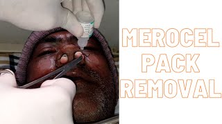 Merocel pack removal [upl. by Ariat]