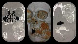 mandibular fibrous dysplasia CT scan and 3D reconstruction [upl. by Asyar750]