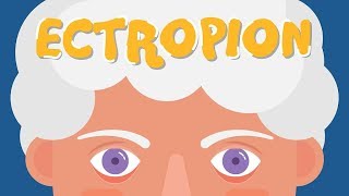 What is Ectropion [upl. by Ettezil]