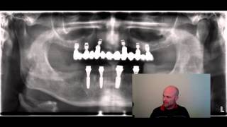 Oberkiefer Implantate auch ohne Knochenaufbau möglich [upl. by Lietman]