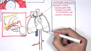 Lung Carcinoma Lung cancer [upl. by Sil865]