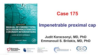 Case 175 Manual of CTO PCI  Impenetrable proximal cap [upl. by Eimma718]