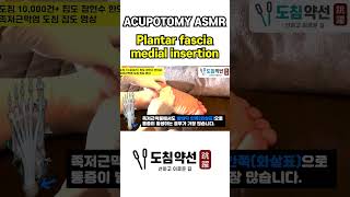 ACUPOTOMY ASMR Plantar fascia  Calcaneus insertion [upl. by Bollinger860]