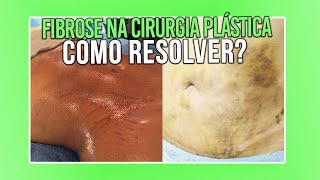 5 COISAS QUE VOCE PRECISA SABER PARA NAO TER FIBROSE NA CIRURGIA PLÁSTICA [upl. by Arvo424]