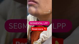 Segmental lichen Planus Pigmentosus Treatment drashimagoel skincare parisaskinclinic [upl. by Tamarah]