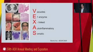 5Inflammaging comorbidities and VEXAS syndrome in MDS pathogenesis [upl. by Dnallor]