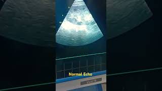 Echo Screening Vedio  Heart Ultrasound  Echocardiography Heart chamber  Heart pumping Test [upl. by Tengdin]