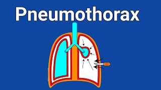 Pathophysiology of Pneumothorax  Treatment of Pneumothorax in Hindi [upl. by Christoper]