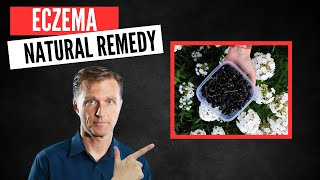 Best Natural Remedy for Eczema [upl. by Bernstein8]