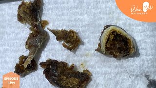 1144  Dead Skin Coated Ear Wax Plugs Removal [upl. by Tigirb]