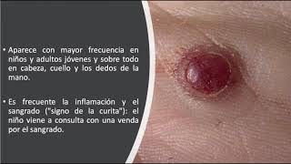 Dermatoscopia de los tumores vasculares [upl. by Namyw]