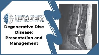 Degenerative Disc Disease Presentation and Management [upl. by Franck]