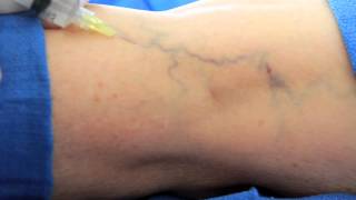 Surface Sclerotherapy at VēNA Clinic [upl. by Oskar]