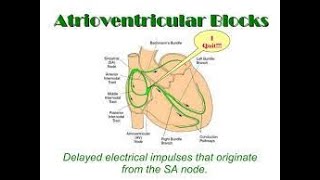 Atrioventricular Block  AV blocks made easy  AV block ECG interpretation  Types of AV Block [upl. by Walter]