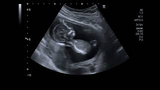 Beautiful Ultrasound Video of 14 Weeks Pregnancy Baby Girl [upl. by Burkle]