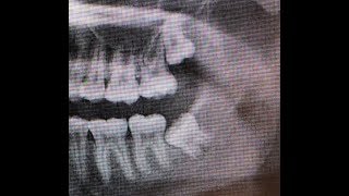 Dental Video of Full Bony Impacted Wisdom Tooth Removal [upl. by Britney436]