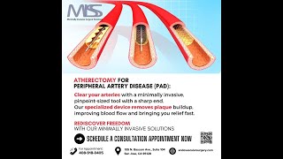 Clear Arterial Blockage With Atherectomy at MISS [upl. by Nnylidnarb]