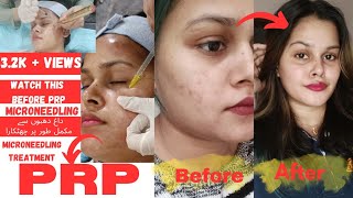 prp microneedling treatment kia hota haiPRP micro needling kese hota haifull explained in urdu [upl. by Quinta70]