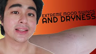 SIDE EFFECTS OF ISOTRETINOIN ACCUTANE ACNETREX❌❌❌  7th Month Progress Video  KevInSeries [upl. by Anavas]