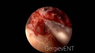 Endoscopic epitympanic cholesteatoma surgery  Эндоскопическое удаление холестеатомы эпитимпанума [upl. by Collins596]