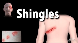 Shingles Pathophysiology Symptoms 3 stages of Infection Complications Management Animation [upl. by Lateehs]